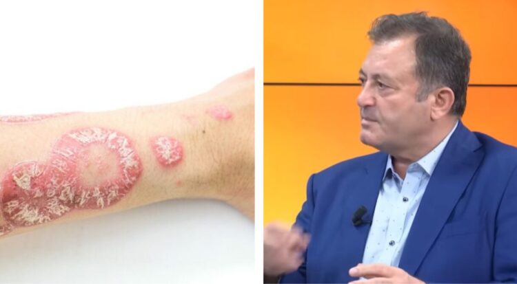 Ylli Merja, Psoriaza
